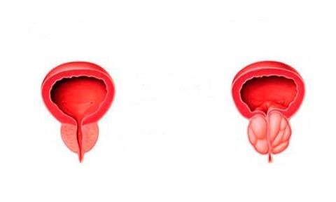 A healthy and inflamed prostate (with prostatitis)